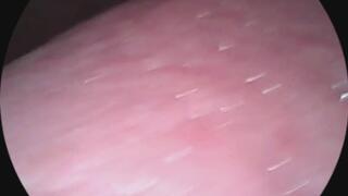 endoscope- close detail of tongue