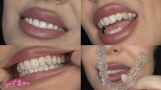 New exciting aligners update | Sweet Maria