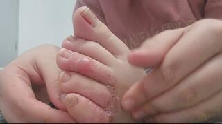 Dirty toenails, chewed and exposed