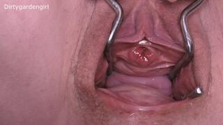 Close Up Urethra & Cervix Prolapse