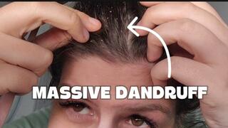 Massive Dandruff Scratching with Fork Watch the Flakes Fall (Scalp Fetish)