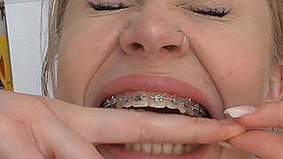 Bites her hands with her teeth with braces! MP4
