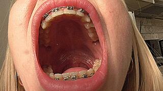 Wide mouth yawning with braces and rubber bands! MP4