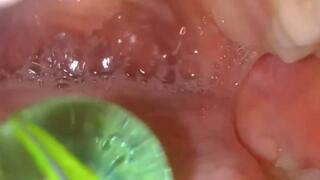 Exploration of stomach marbles with pillcam 720HD