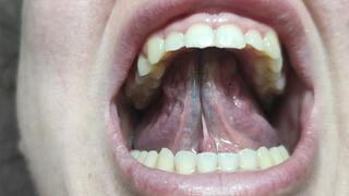 Crooked teeth and without molars