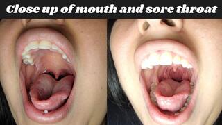 Close up of mouth and sore throat