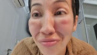 Post facial treatment