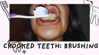 Crooked teeth: brushing clean