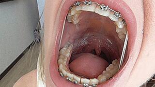 Big mouth with rubber bands! MP4
