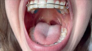 Retainer Mouth Tour