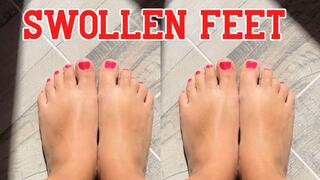 Swollen feet