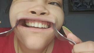 Morning inspection of yellow teeth with forks