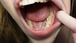 I tell you about the fillings in my teeth and dental visits