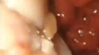 Whole chicken digestion endoscopy 720HD