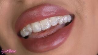 A new aligners update video | Sweet Maria