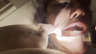 See my oral fistula and help me get a root canal soon (July 25 2025)