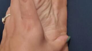 Dry soles need attention