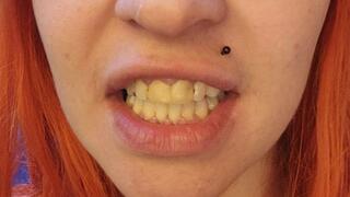 Exploring My Mouth - Extremely Yellow and Rotten Teeth