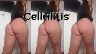 Close-up of my cellulite