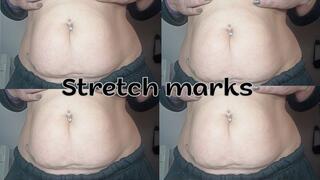 Stretch marks on my belly
