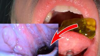 Gummy Bears Swallowed Whole + Endoscope