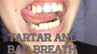 Yellow teeth - tartar
