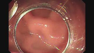 Endoscope Progression