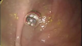 Confirming the movement of 3D MACE under gastroscopy