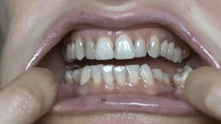 Giò rotten teeth