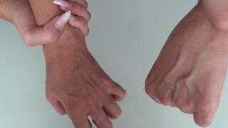 LARGE VEINS ON THE ARMS
