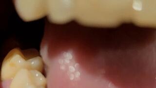 A new missing tooth! A tooth broke, teeth are rotten than ever - nicotine efects