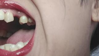 Guess how many molars l'm missing