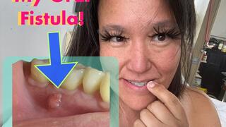 ROOT CANAL Tooth #46: I show you my Endodontics Referral Form. I did not know how teeth were counted! (oct 6 2025)