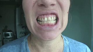 Dental fillings on my teeth