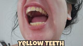 Brushing My Yellow croocked and Dirty Teeth After 7 Days – Real Oral Hygiene With Close-Ups and Spit
