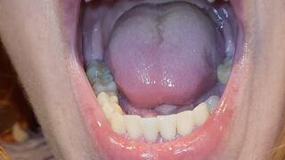 My teeth are rotting even more! Lost tooth progress - Best quality