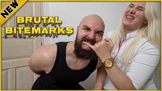 Aggressive Finger Biting: Brutl Bitemarks