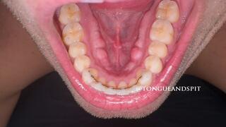 Andrew Bottom Teeth and Retainer Part19 Video1 - MP4