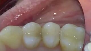 Total reconstruction of two lower molars with composite 1080HD