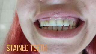 Stained teeth