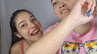 Burning bite with visible marks