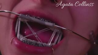 Metal Attraction: The art of a perfect smile.