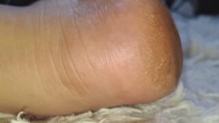 the imperfections of my feet