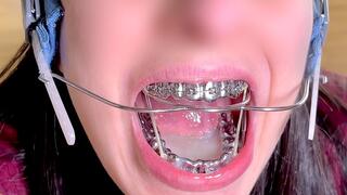 Braces HEADGEAR & HERBST cum in mouth