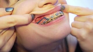 BRACES DIARY Showing my Braces with A Closeup Lens