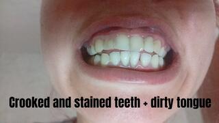 Crooked and stained teeth + dirty tongue
