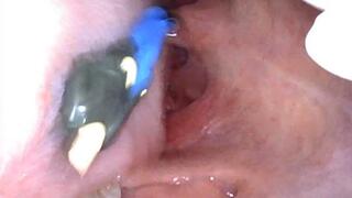 Sasha Swallows A Tiny (ENDOSCOPE FOOTAGE)