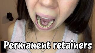 Show you my permanent retainers