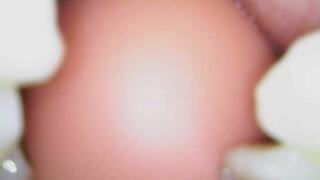 Using endoscope and cheek retractors showing side teeth and back teeth using gummy bears too