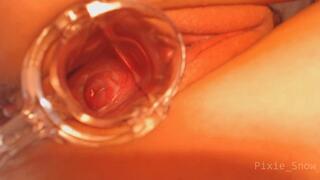 Speculum Cervix Exploration